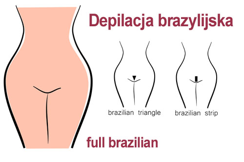 Depilacja brazylijska, bikini brazylijskie
